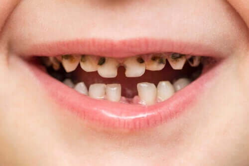 Les caries infantiles sont-elles contagieuses ?