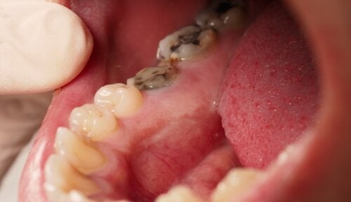 Dentinogenèse imparfaite : tout ce que vous devez savoir