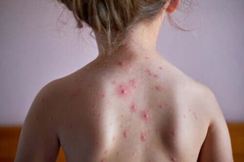 Le zona: de quoi s'agit-il? Comment affecte-t-il les enfants?