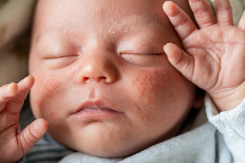 Mon bébé a la peau réactive
