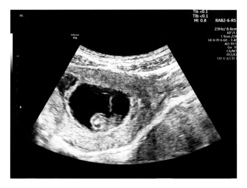 Échographie à 6 semaines de grossesse: que peut-on voir ?
