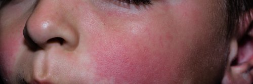 Erythème infectieux chez les enfants