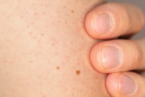 Comment prendre soin de la peau avec kératose pilaire chez les enfants ?