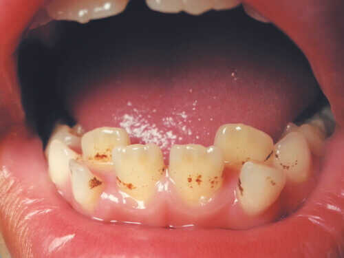Taches sur les dents des enfants dues à la supplémentation en fer