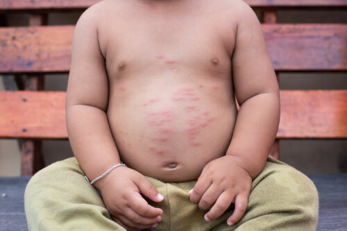 Enfants et allergies cutanées: symptômes et recommandations