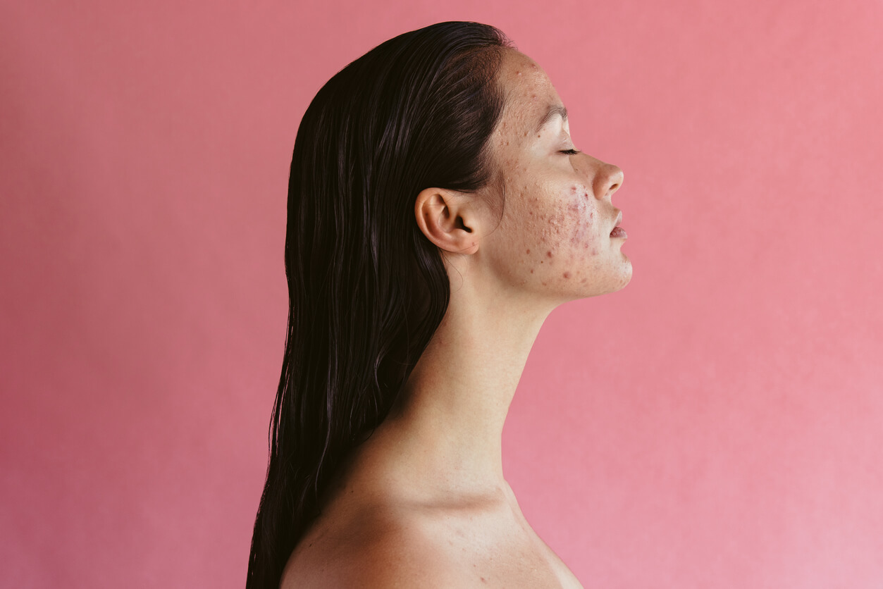 Pourquoi l’acné apparaît-elle à l’âge adulte et que faire pour la traiter ?