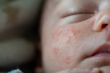 Lésions bénignes sur la peau du bébé : types et soins