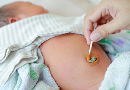 Omphalite ou infection du nombril chez le nouveau-né