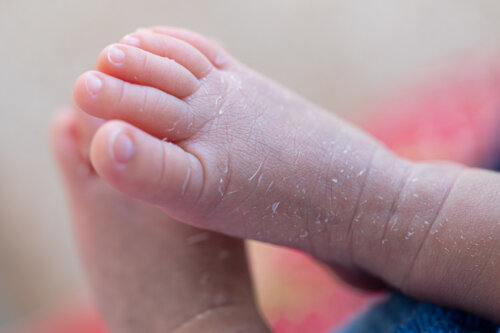 Causes de la desquamation de la peau chez un bébé