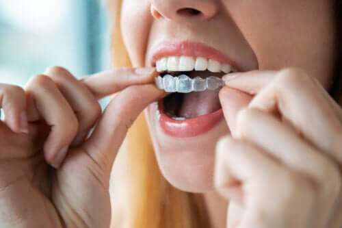 Comment nettoyer les appareils orthodontiques amovibles