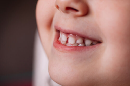 Que faire si votre enfant ne perd pas ses dents de lait ?