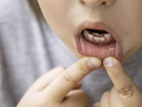 Dents surnuméraires : causes et traitement