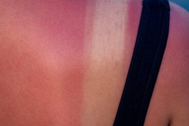 Coups de soleil pendant la grossesse : risques et traitement