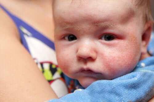 Pétéchies chez le bébé: symptômes, causes et traitement