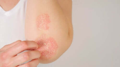 Psoriasis et grossesse : ce que vous devez savoir