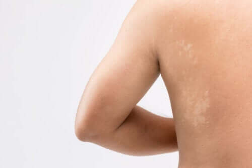 Pityriasis versicolor chez les enfants : causes, symptômes, traitement