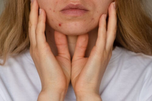 Quelles sont les causes de l'acné à l'adolescence ?
