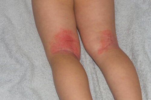 Érythrodermie chez les enfants : symptômes, causes et traitements