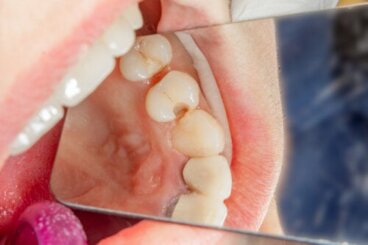 Dents de lait avec des caries : pourquoi vaut-il mieux les traiter que les retirer ?