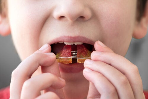 Orthodontie infantile: à quel âge peut-elle commencer ?