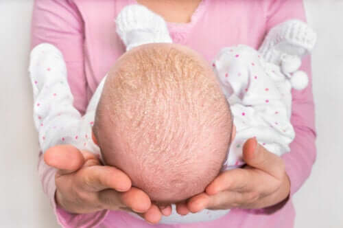 Dermatite séborrhéique infantile
