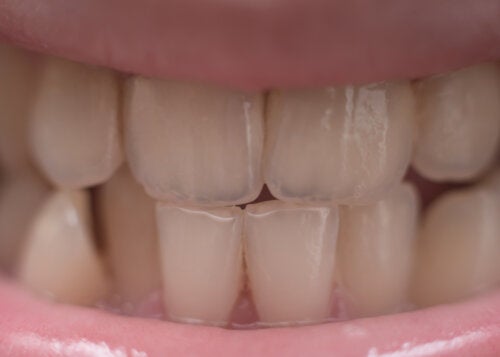 Le fluor peut-il décolorer les dents des enfants ?