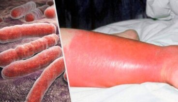 L'érysipèle dans l'enfance