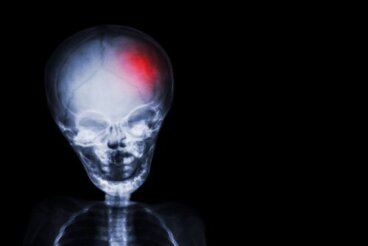 Ictus chez les enfants : ce que vous devez savoir