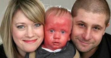 Syndrome de Netherton : les enfants à la peau rouge