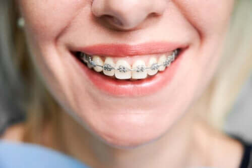 L'orthodontie peut-elle être utilisée pendant la grossesse ?