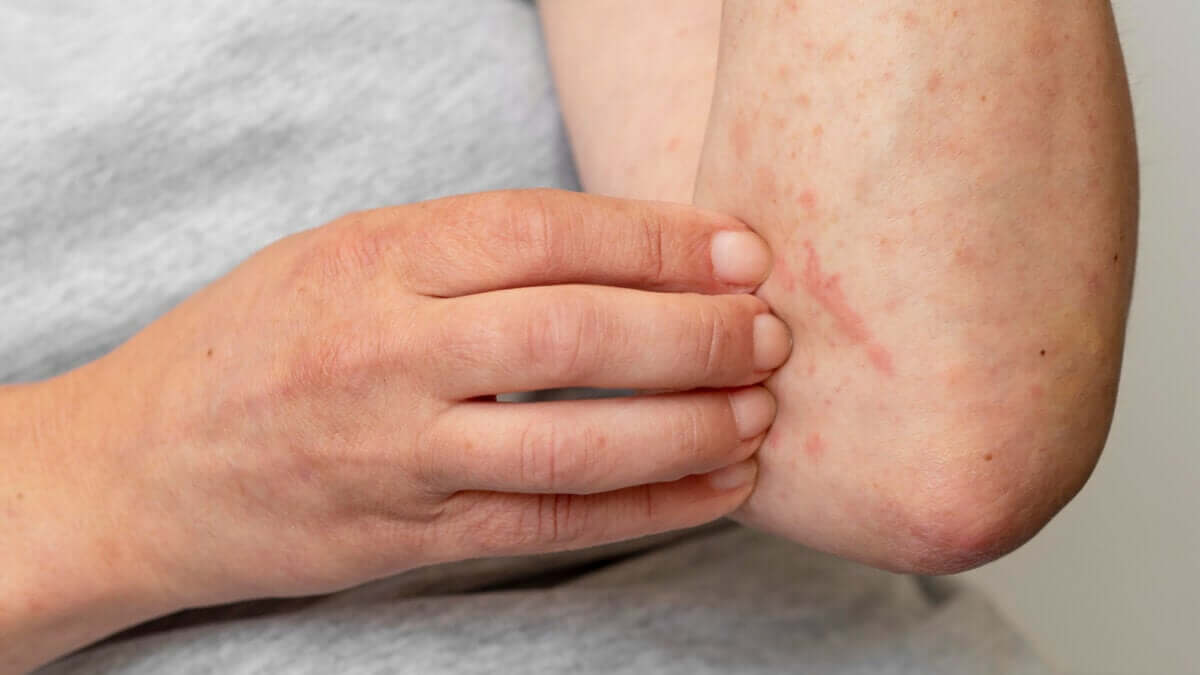 Comment éviter les cicatrices de Monkeypox chez les enfants ?