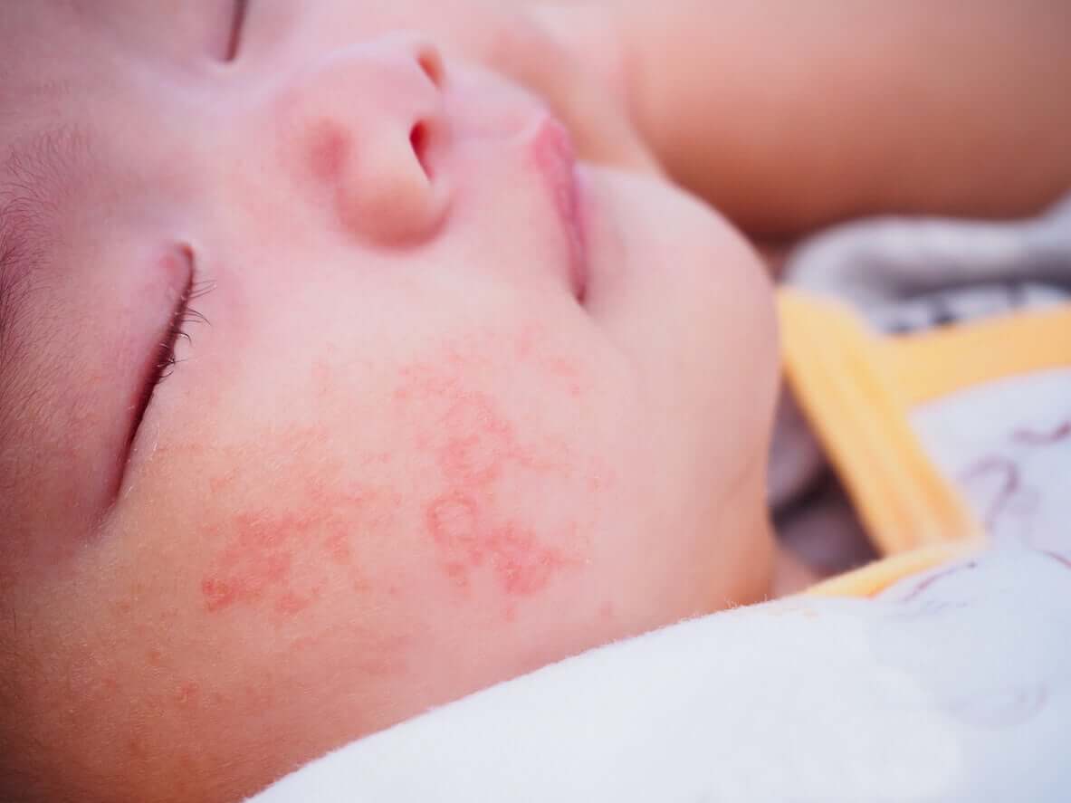 Types d’allergies cutanées les plus courantes chez les bébés