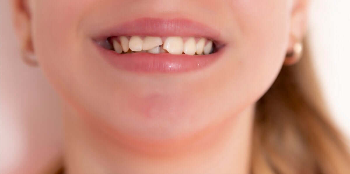Dents cassées chez les enfants : causes et solutions